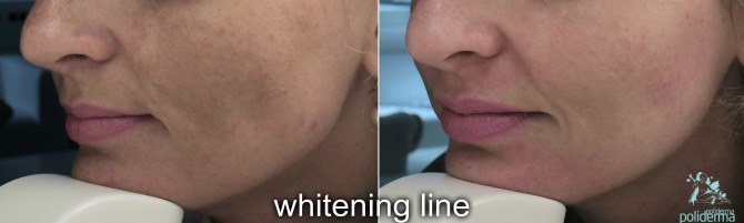 Rezultati primjene kreme White Skin 1 nakon 30 dana: pigmentacije na licu znatno su nestale